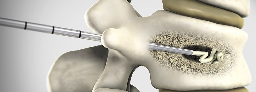 cifoplastia