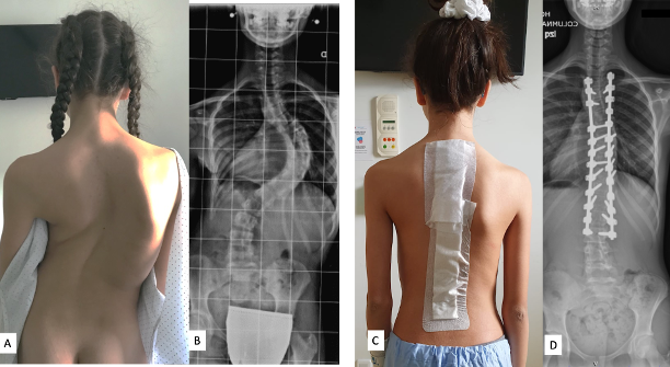 Caso representativo:
• Adolescente de 14 años con escoliosis idiopática torácica progresiva.
• A,B: Fotografía clínica y radiológica preoperaatoria. Curva torácica (T6-T10:85º) .
• C,D: Resultado tras la corrección quirúrgica y restablecimiento del equilibrio del tronco